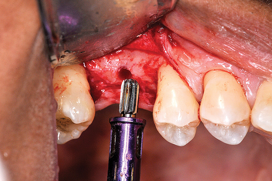 The crestal sinus osteotomy is completed with the 7mm stopper on the SD reamer.