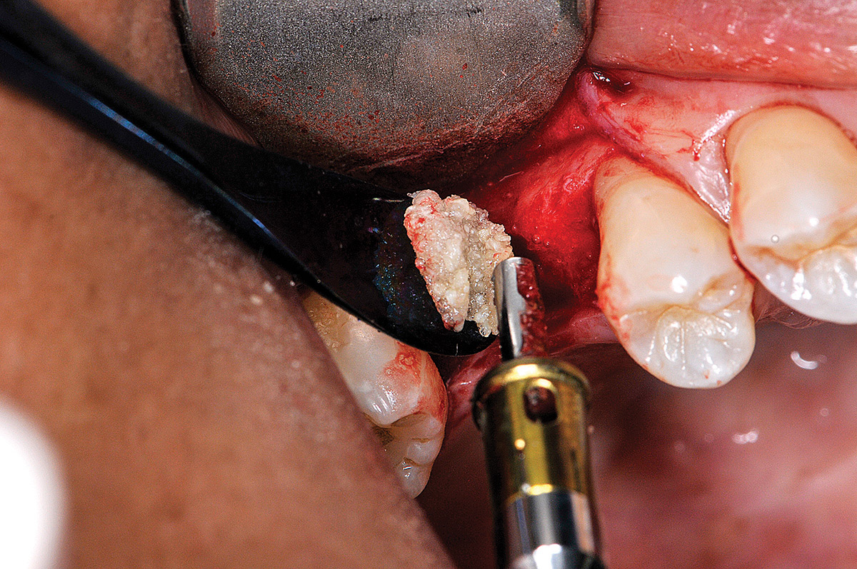 The bone packing instrument with stopper packs the PRP gummy bone into the osteotomy to elevate the sinus and gain crestal height in preparation for the implant to be placed.