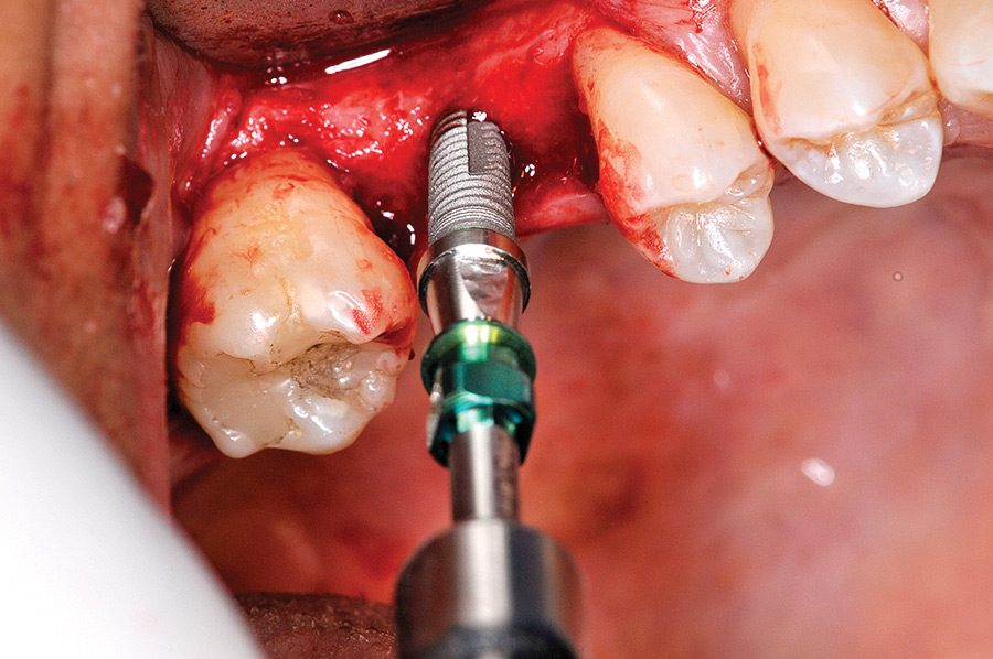 The implant is introduced into the crestal sinus elevation osteotomy.