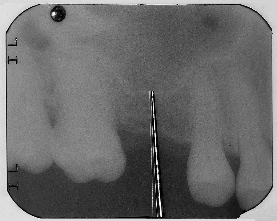 Radiograph demonstrating insufficient crestal height to house an implant