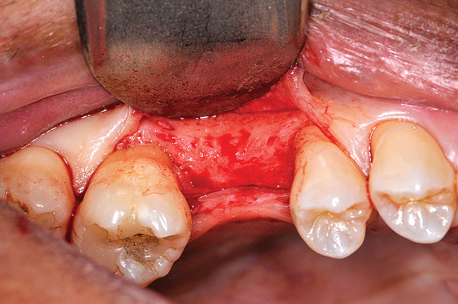 Envelope flap has been elevated to expose the residual crest at the edentulous site that will have an implant placed.