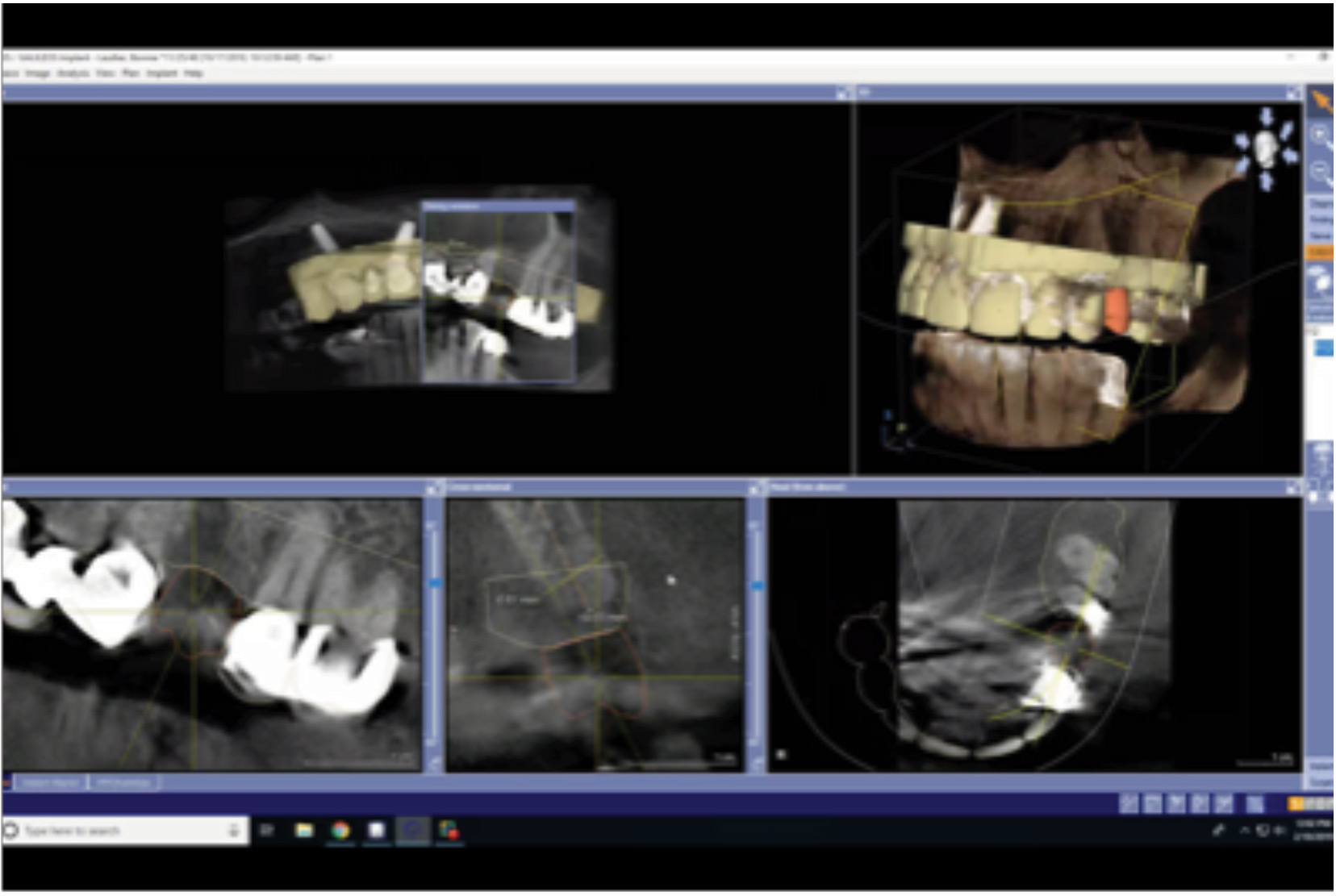 Completed stitch of CAD/CAM data to CBCT.