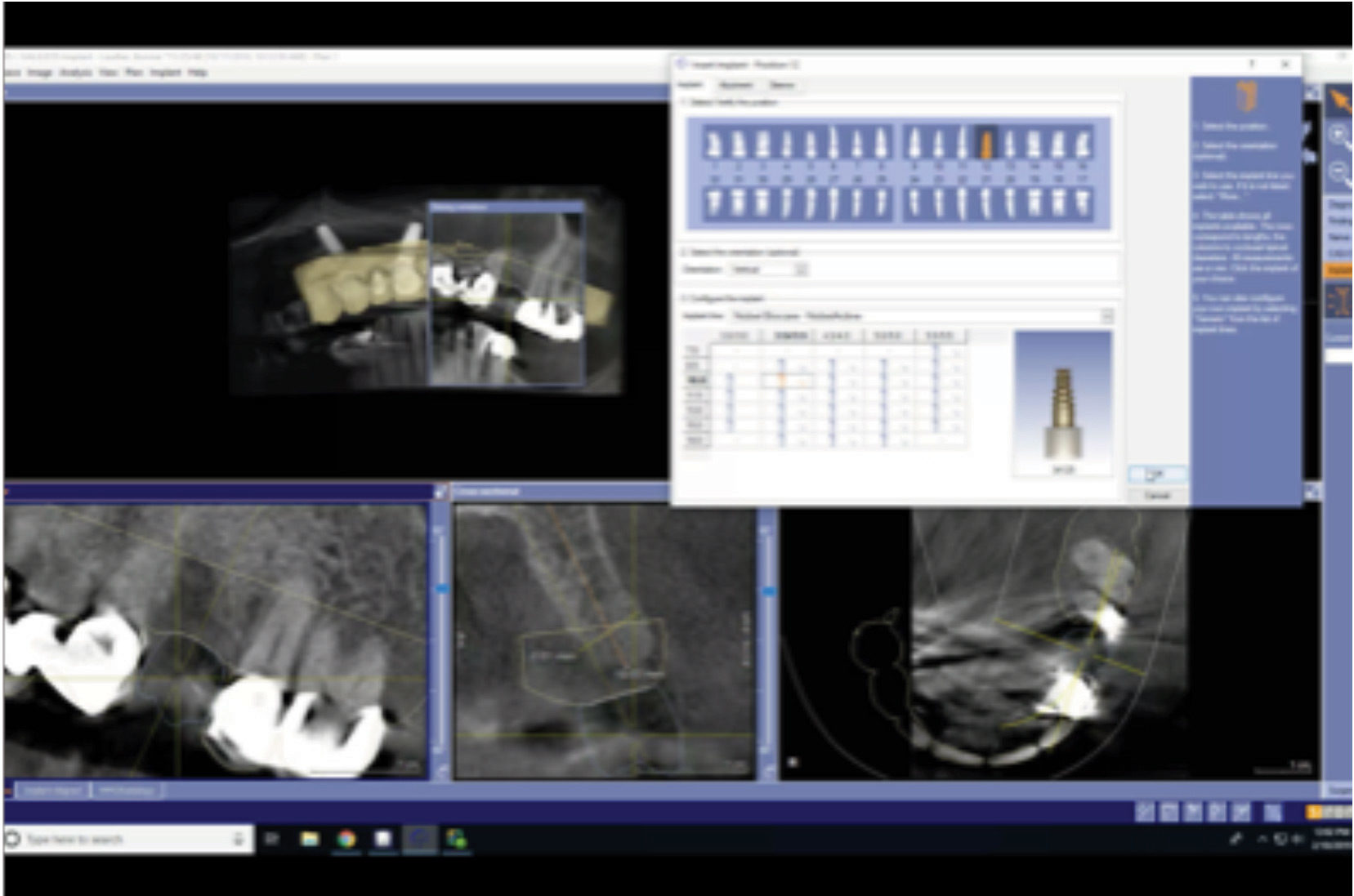 An example of selecting a 3.5_mm x 10_mm nobel implant.