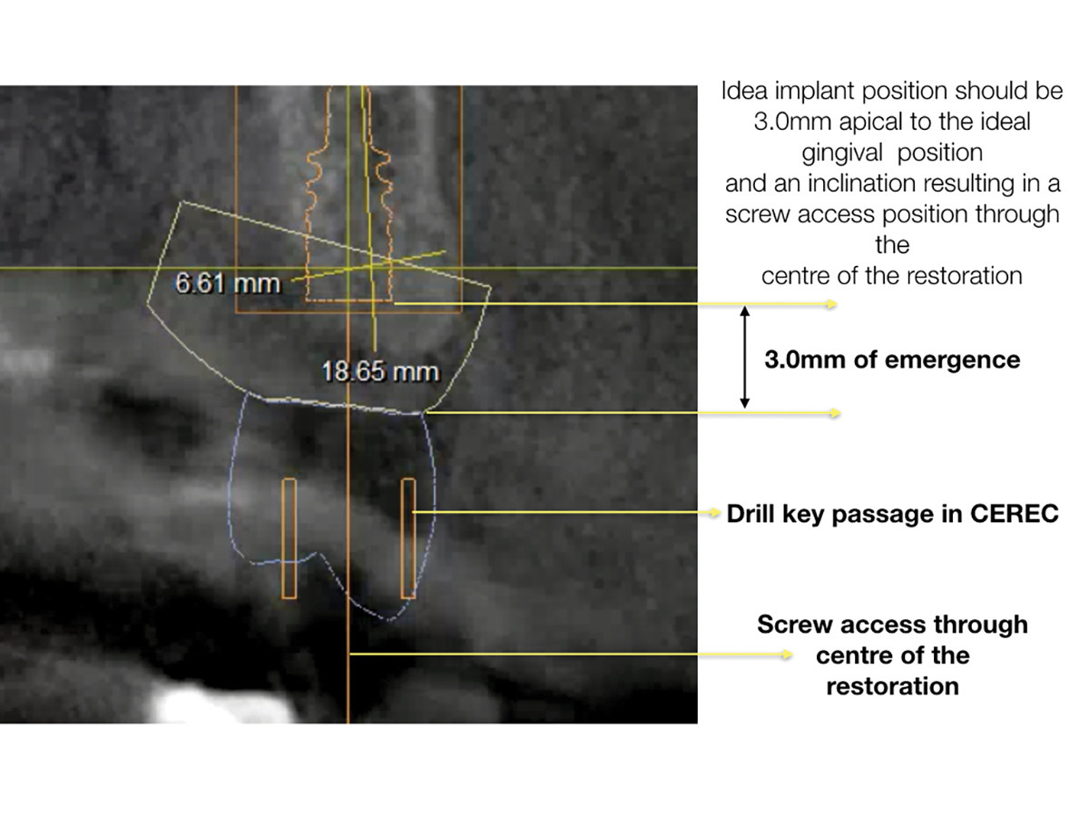 Measuring and ensuring the 3.0 mm apical placement to ideal gingival growth.