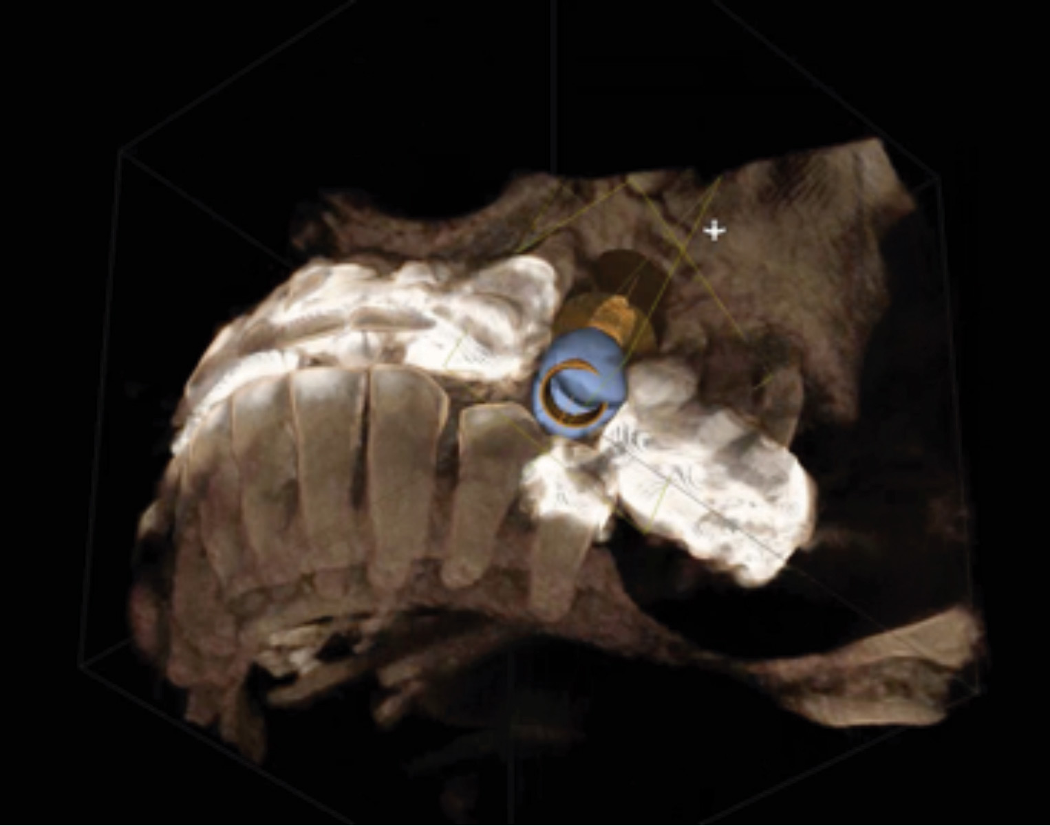 Final implant placement. CEREC