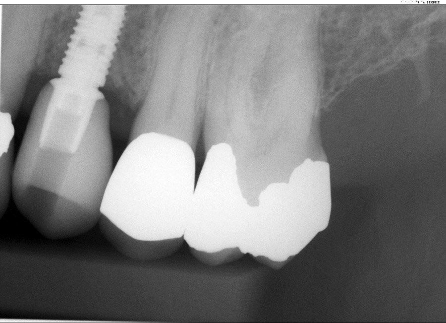 Insertion of screw down crown and 3 week recall. Initial placement. 3 weeks post-op. notice papillae.