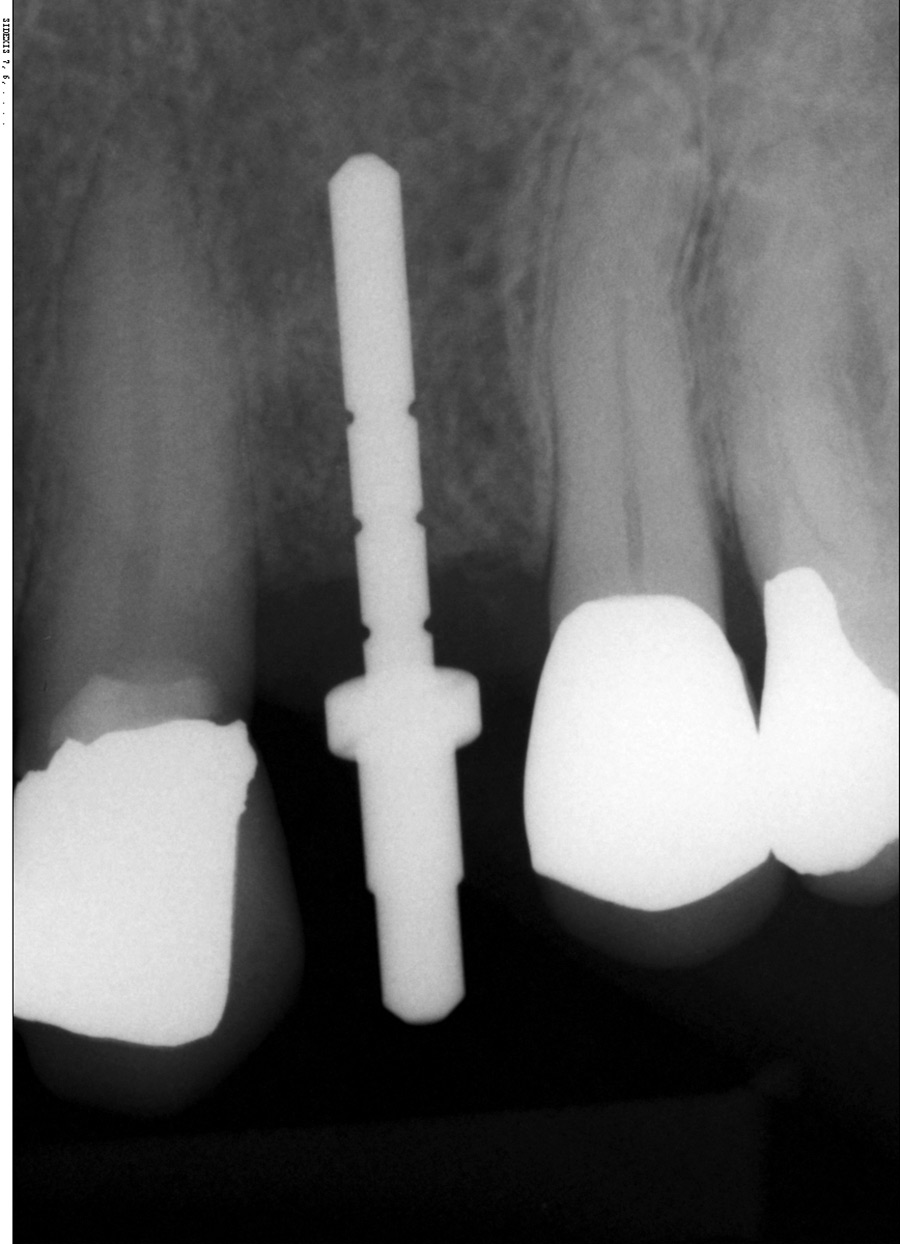 Guided surgery of a Nobel 3.75 mm implant.