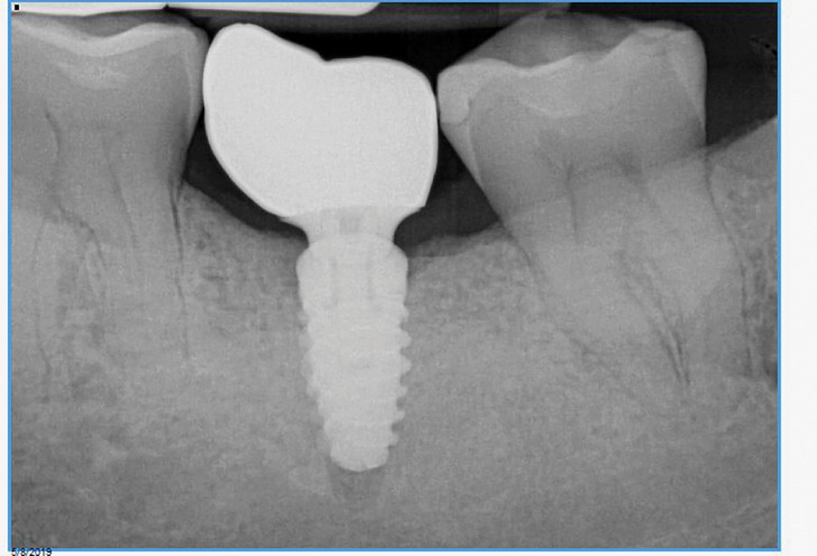 Bone grafting