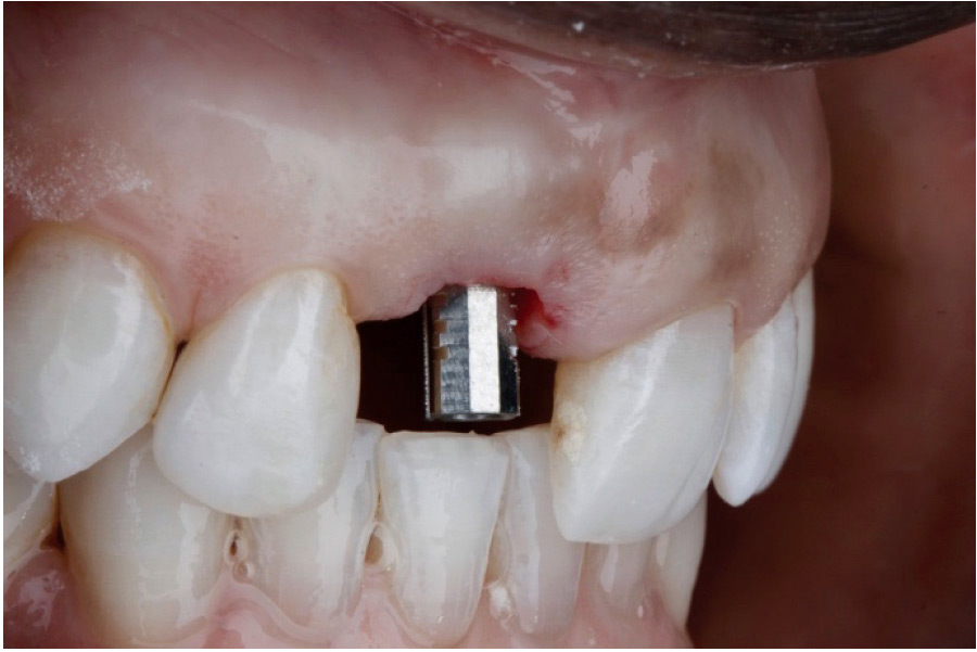 Following implant integration, try-in of a provisional temporary abutment is performed and adjusted.