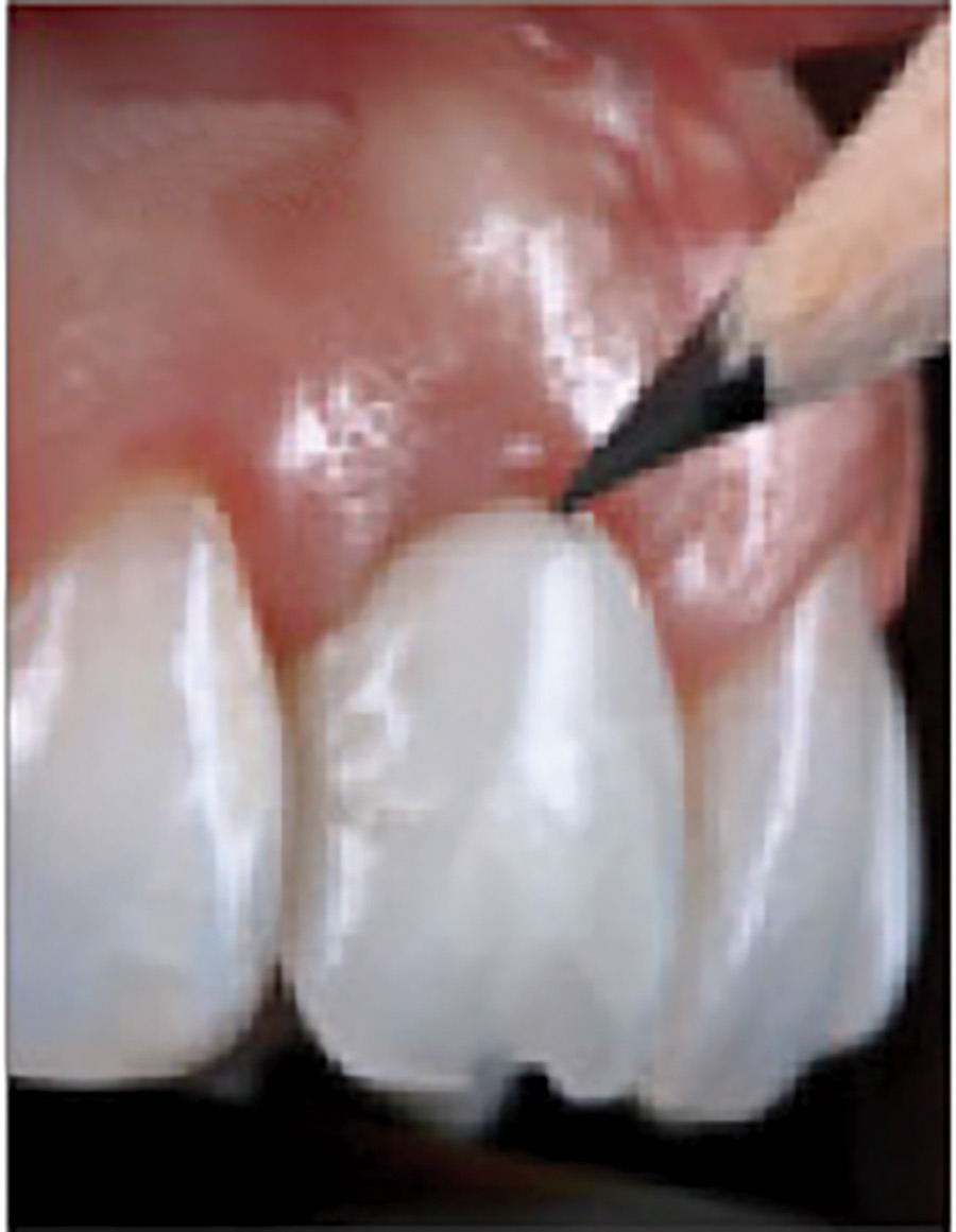 The Gingival Zenith is outlined to allow for extra-oral adjustments to be performed.