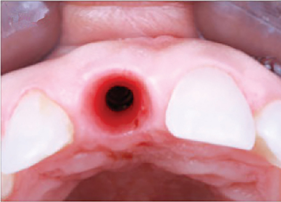 Note the quality of the tissue following initial tissue conditioning.