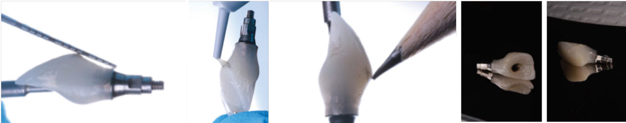 Extra-oral Adjustments to the provisional restoration are made based on the predetermined gingival zenith adjustments.