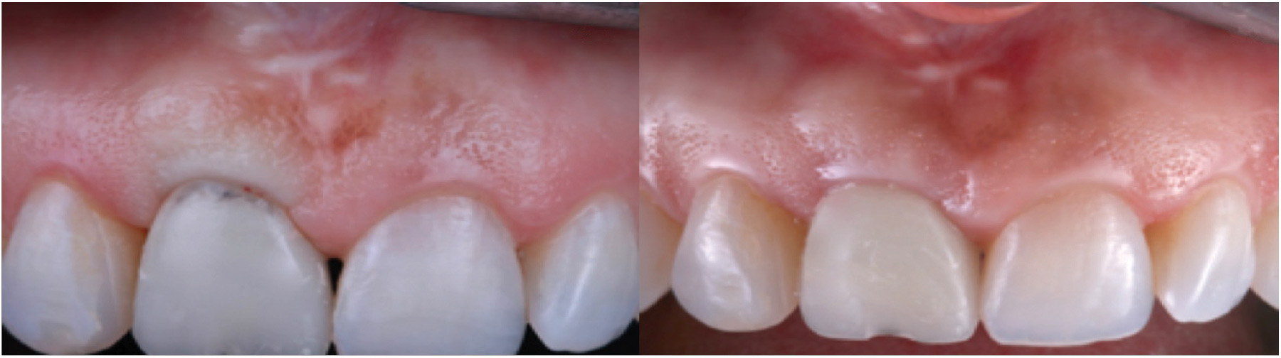 . Immediately post insertion of the modified provisional restoration showing blanching of the tissue due to the temporary indicating ischemia caused by the new provisional contours.