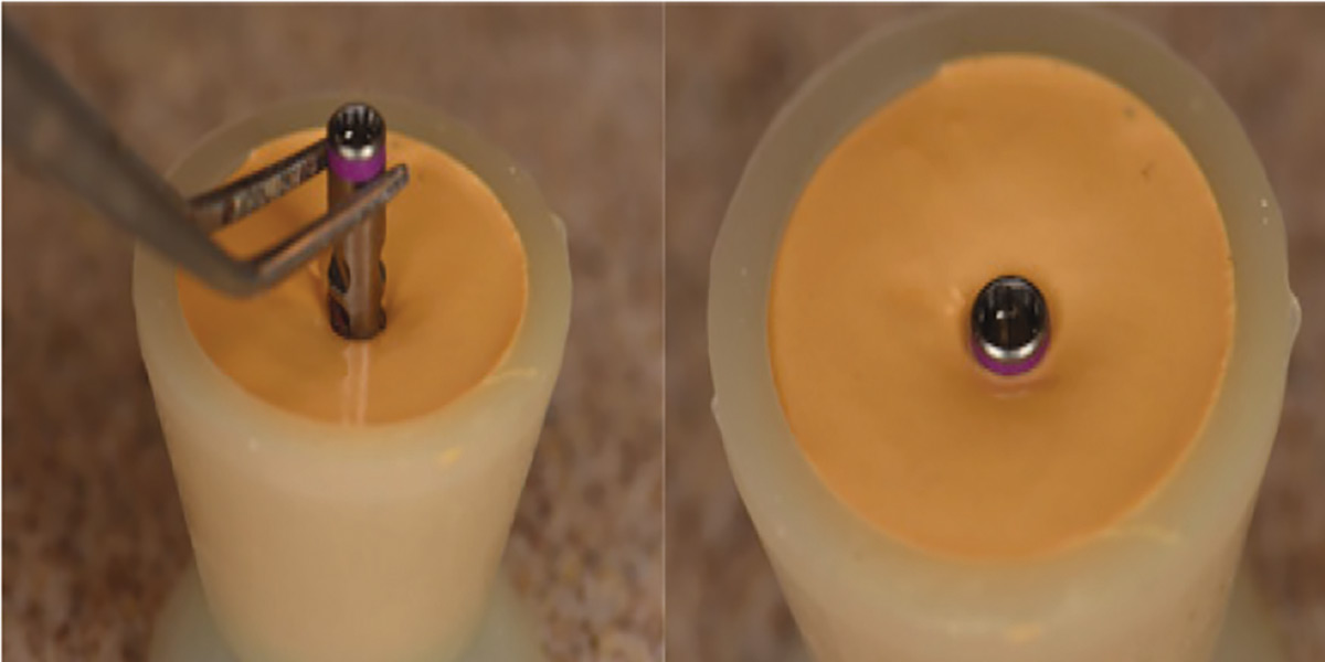 the implant analogue is fixated using a stone base and an impression of the subgingival contours of the crown will be made to be transferred to create a custom impression coping.