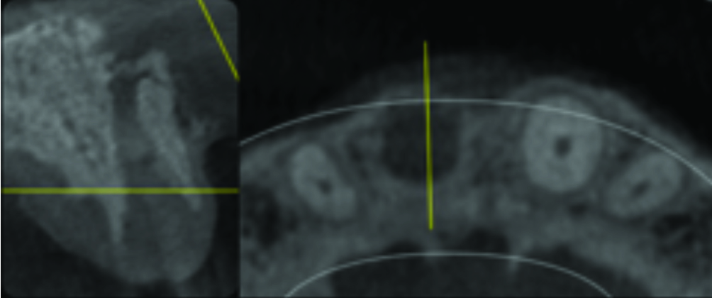 Pre-operative condition following implant failure in site of a maxillary right central incisor.