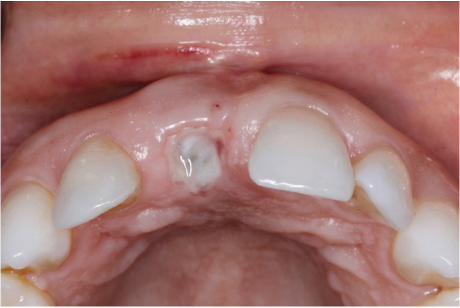 Immediate Post surgical view and 5 days post-operative view of the surgical site.