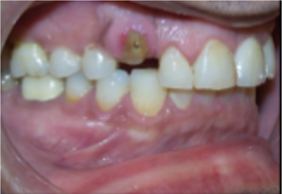 At the completion of orthodontic treatment, the 13 is ready to be extracted and an implant placed. 