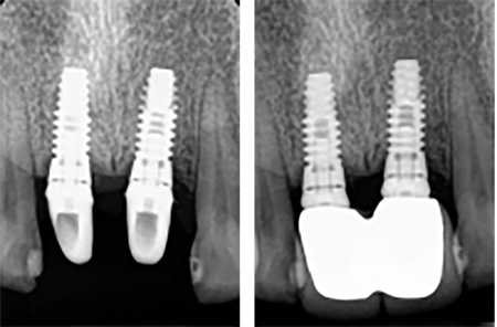 X-ray images with modified stock abutments and their retained crowns with wide open margins. 