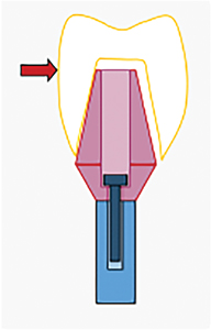 Red arrow represents a tight contact that shoves the crown laterally and exacerbates crown fit problems. 