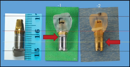 The red arrows designate the extent of excess cement below the gingiva with an abutment margin 1 mm or 2 mm subgingival before crown cementation. The silver part below the abutment is the implant analogue. 