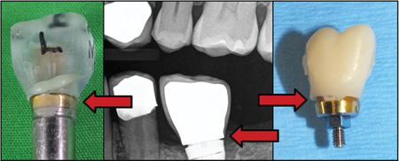 Red arrows show open margins in experiment, x-ray image and removed abutment-crown complex. 