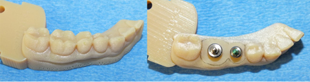 The lower printed model shows the outline of a molar and an adjacent premolar that have been ground down to the tissue level. There is a 5.7 mm and 4.5 mm diameter stock healing abutment positioned in the center of each tooth respectively. Note the large size discrepancy.