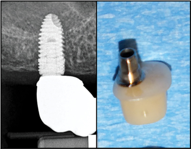 Show the flat profile of the tissue facing surface of a hybrid custom abutment. 