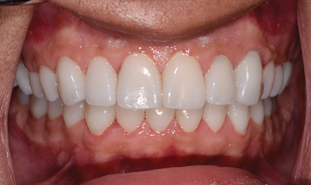 Intraoral and extraoral views at the completion of Prosthodontic treatment.