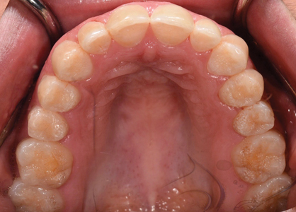 Occlusal views. Note the pitted occlusal surfaces.