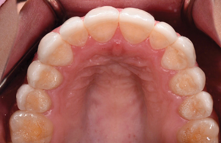 Post-operative maxillary occlusal view.