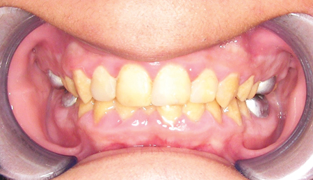 Maximum intercuspation view before starting orthodontic treatment.