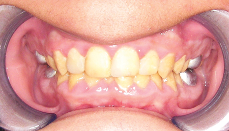 Maximum intercuspation view before starting orthodontic treatment. 