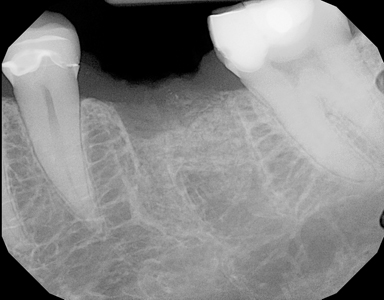 Pre-Operative radiograph of 36 edentulous site. 