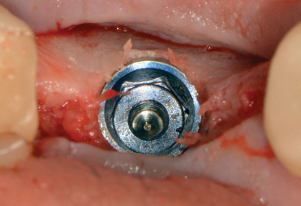 NobelParallelTM CC WP implant in final position and guide removed.