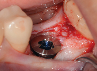 Nobel Biocare WP On1TM base seated into implant. Note depth of implant placement.