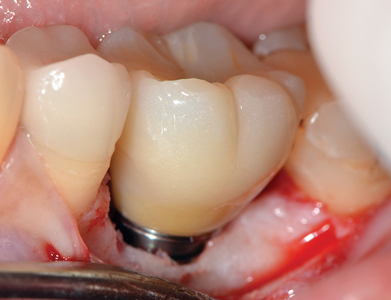 Final monolithic zirconia screw-retained hexed crown seated Nobel Biocare WP On1TM base and torqued to 35 NCm.