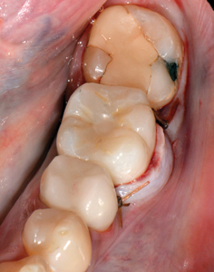 Flap advanced and sutured in place around final crown. Access hole filled. 