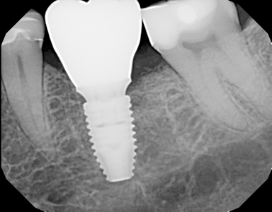 One-year post-operative radiograph implant surgical-prosthetic site.