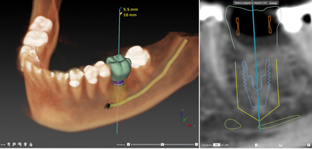 DTX StudioTM initial digital planning. Green is the digital rendering of the desired final tooth position. (Digital Wax-up).