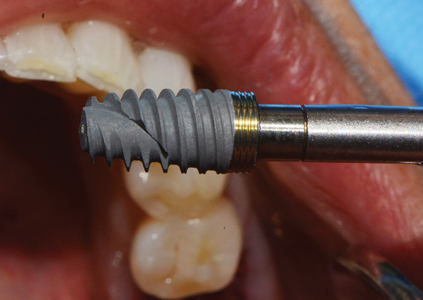 NobelActiveTM TiUltraTM wide platform (WP) implant. 