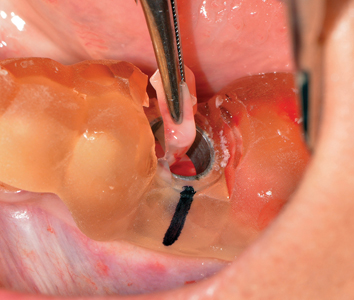 L-PRF being placed into osteotomy prior to implant placement. 