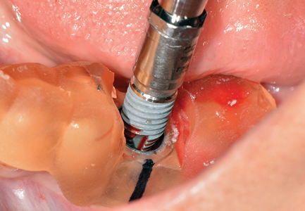 Molar placement of a NobelParallelTM CC WP implant.