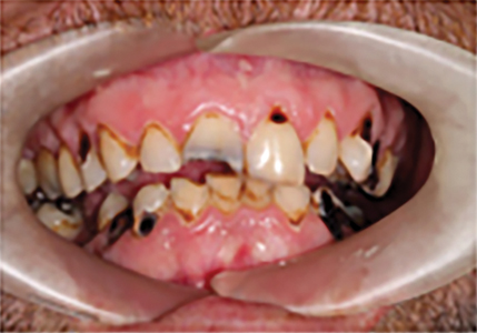 Double arch conversion using implant supported fixed prostheses made possible by angled abutments.