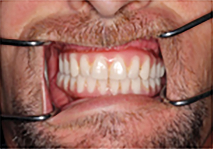 Double arch conversion using implant supported fixed prostheses made possible by angled abutments.