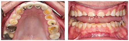 Severe attrition due to parafunctional clenching and grinding.