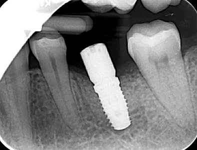 Intraoral periapical radiograph taken after placement of implant #36 with healing abutment connected.