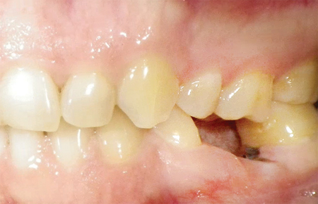 Clinical photographs of #36 prior to treatment and after the implant has been in function for six months.