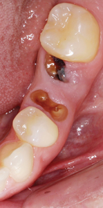  Clinical photographs of #36 prior to treatment and after the implant has been in function for six months. 