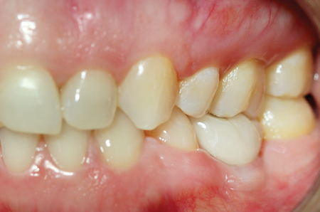 Clinical photographs of #36 prior to treatment and after the implant has been in function for six months.