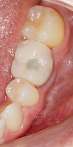 Clinical photographs of #36 prior to treatment and after the implant has been in function for six months.